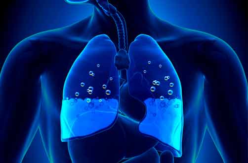  El edema pulmonar y ortopnea