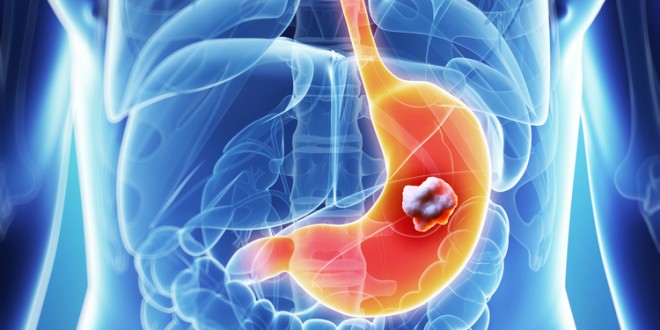  C&aacute;ncer de Est&oacute;mago una enfermedad silenciosa: Estos son los s&iacute;ntomas
