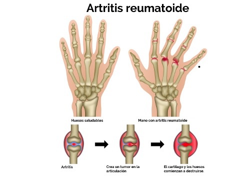 El alivio de la artritis est&aacute; en la naturaleza