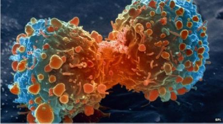 Nueva investigaci&oacute;n asegura que la mayor&iacute;a de los c&aacute;nceres son el resultado de la "mala suerte"