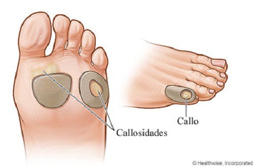 C&oacute;mo tratar naturalmente los callos