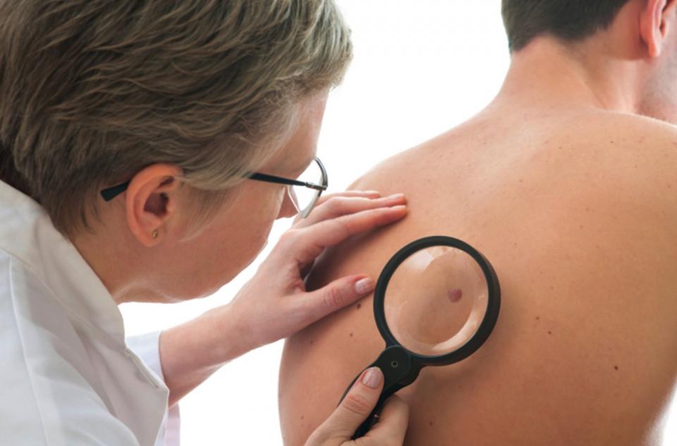Alertan por un c&aacute;ncer de piel poco frecuente pero muy agresivo: c&oacute;mo reconocerlo