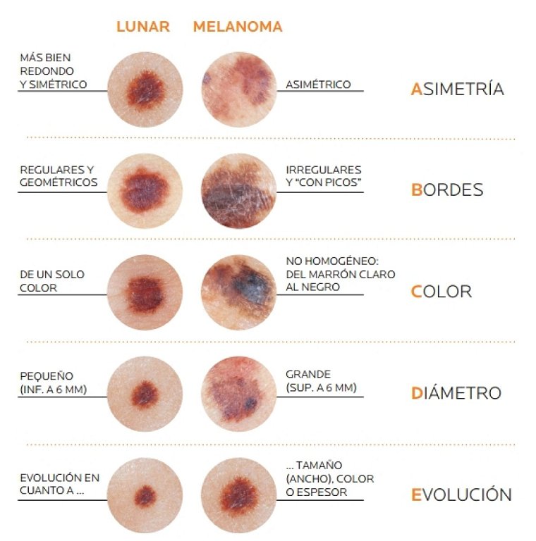 &iquest;Tienes c&aacute;ncer de piel? Aprende a detectar los s&iacute;ntomas