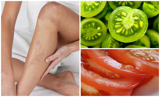 5 excelentes remedios naturales para curar tus v&aacute;rices