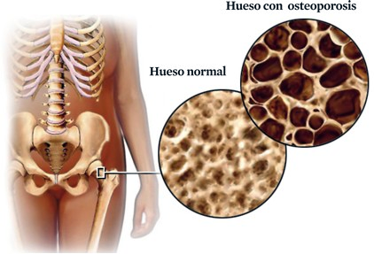 Consejos para prevenir la temible osteoporosis