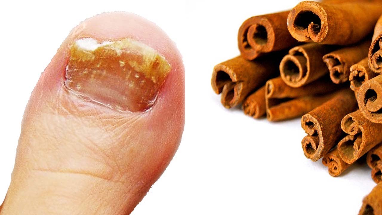 Ning&uacute;n hongo sobrevive a este potente germicida con canela. Aqu&iacute; te decimos como prepararlo