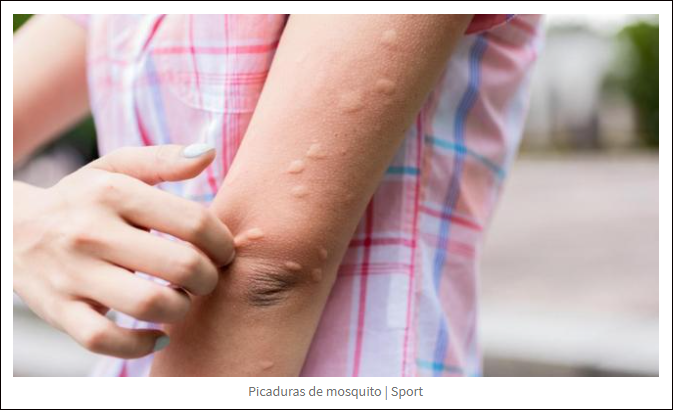  Como rebajar el dolor de las picaduras de mosquitos