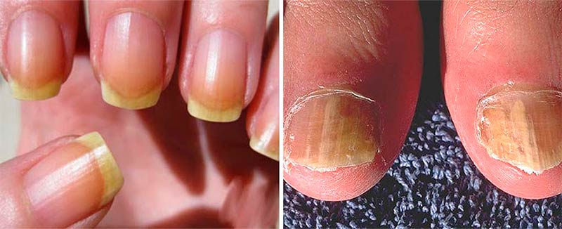 3 Remedios Caseros Para Tratar Las U&ntilde;as Amarillas En Manos y Pies