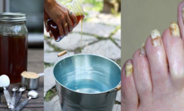 Esta f&aacute;cil receta de 2 ingredientes eliminar&aacute; los hongos de las u&ntilde;as