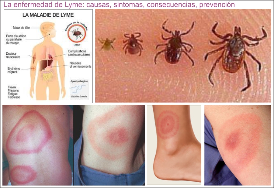 La enfermedad de Lyme, un monstruo invisible