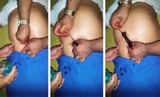 http://inforientalsde.com/internacionales/video-muy-fuerte-sacan-raton-del-ombligo-de-hombre-product