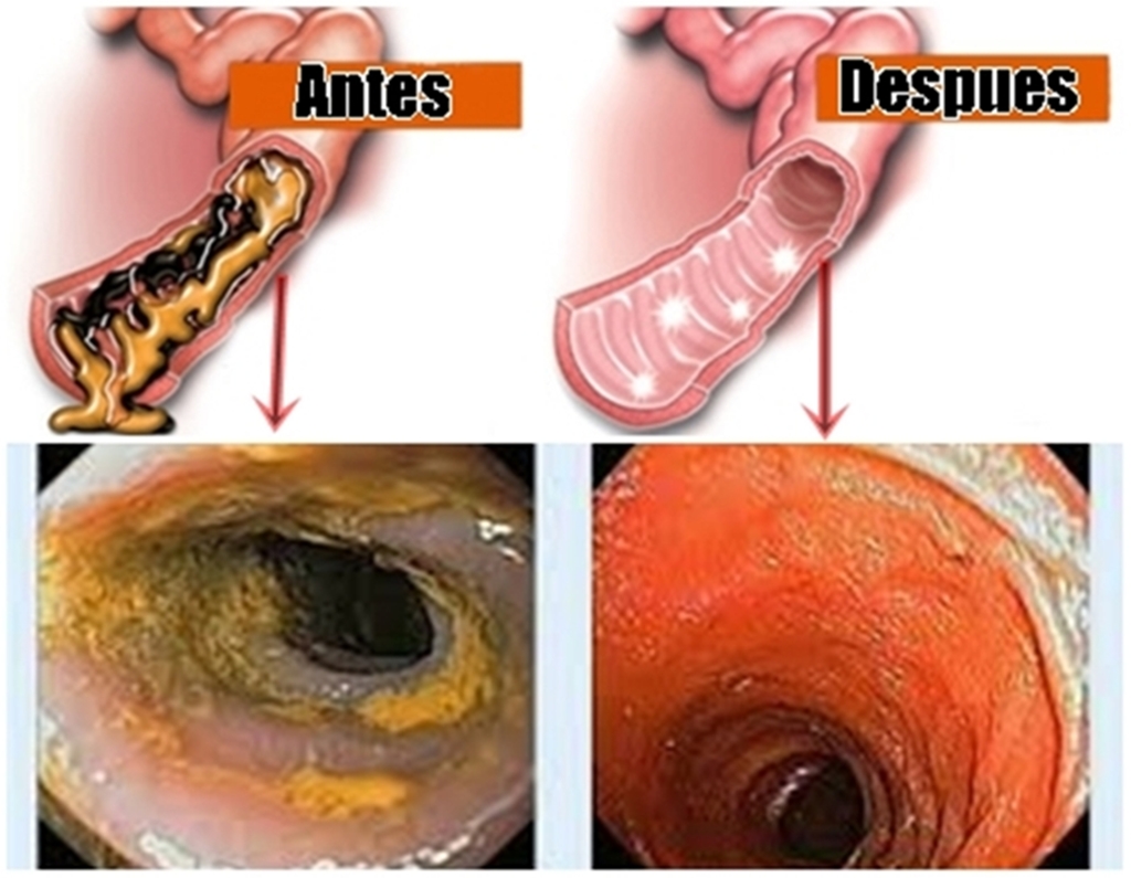 No creer&aacute;s lo que &eacute;sta combinaci&oacute;n de ingredientes le hace a tu colon