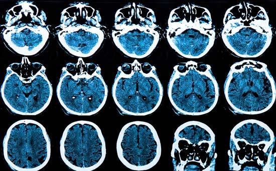 6 consejos para prevenir la enfermedad de Alzheimer: Protege tu cerebro