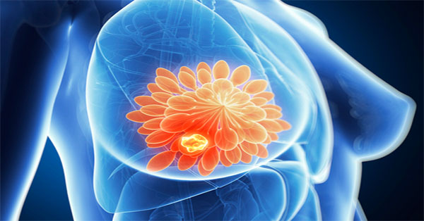 ESTA HIERBA JUNTO CON HIERRO MATA EL 98% DEL C&Aacute;NCER DE MAMA EN HORAS!
