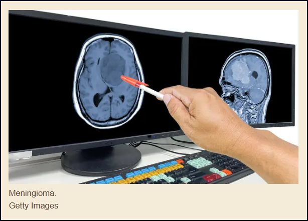 Meningioma: s&iacute;ntomas de alerta de este tumor silencioso y frecuente