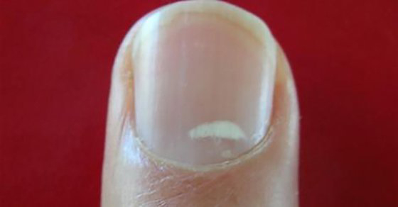 Tienes manchas blancas en las u&ntilde;as? - De esto es de lo que nos avisan!