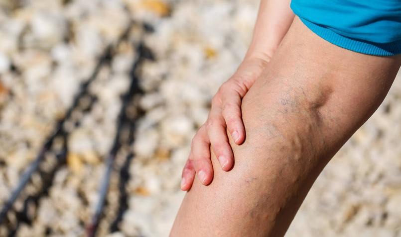 Por qu&eacute; salen varices en verano y c&oacute;mo reducir el dolor que provocan