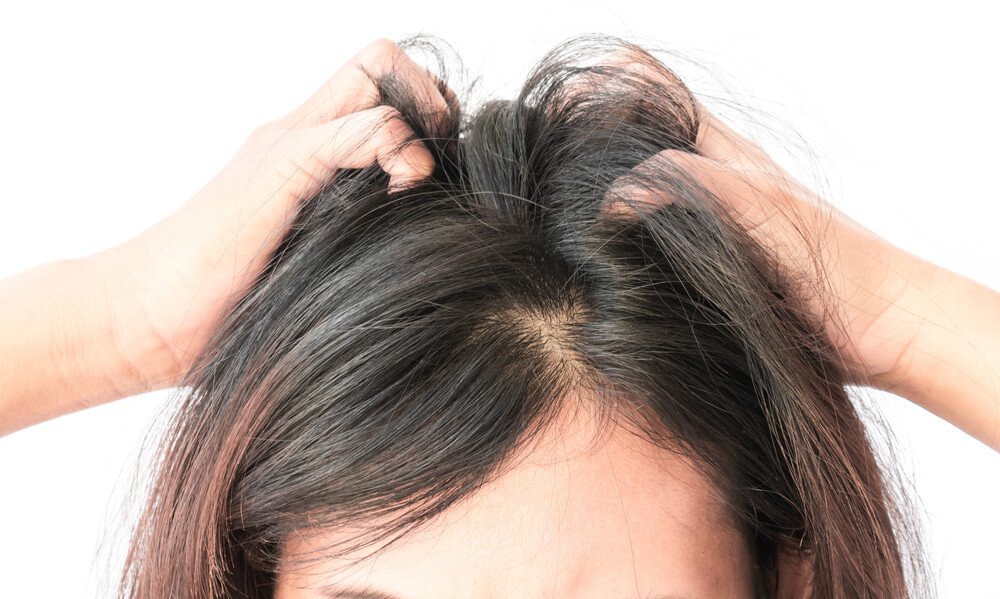 &iquest;Tienes caspa en tu cabello? Dile adi&oacute;s con un tratamiento de huevo