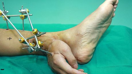 M&eacute;dicos implantaron una mano en un tobillo para que mantenga irrigaci&oacute;n sangu&iacute;nea