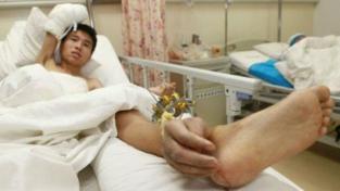 M&eacute;dicos implantaron una mano en un tobillo para que mantenga irrigaci&oacute;n sangu&iacute;nea