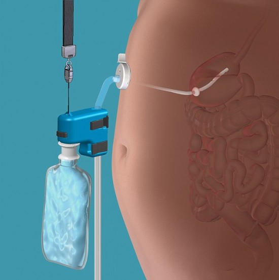 Controversial weight loss device lets you eat like a pig then pumps your stomach