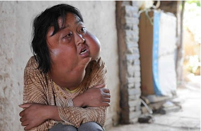 Mujer china desfigurada por los 7 tumores de su cara