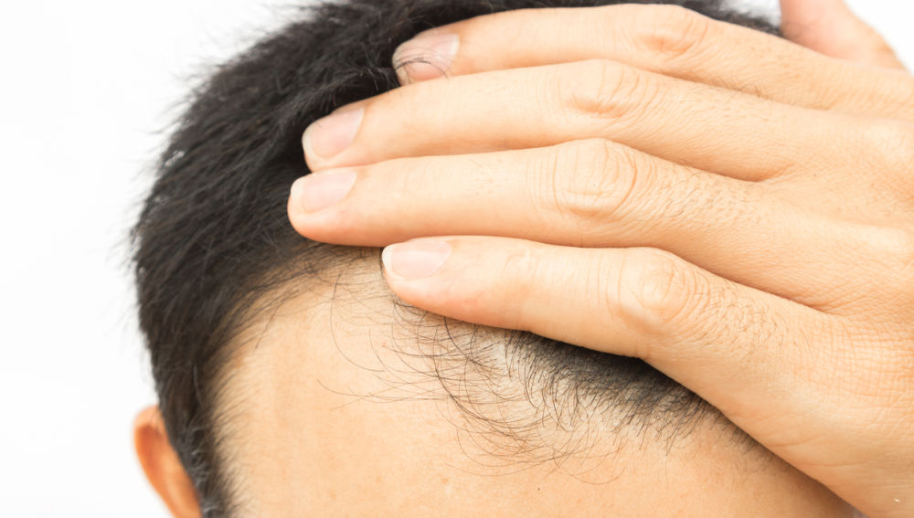 5 se&ntilde;ales que indican que la ca&iacute;da de tu pelo debe preocuparte