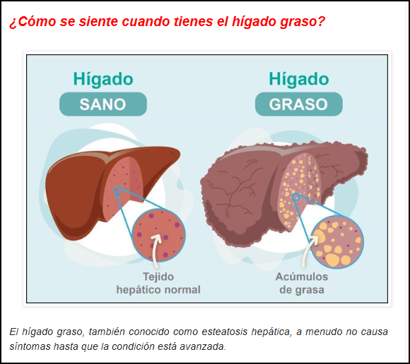  Algunos s&iacute;ntomas que presenta tener un peligroso h&iacute;gado graso