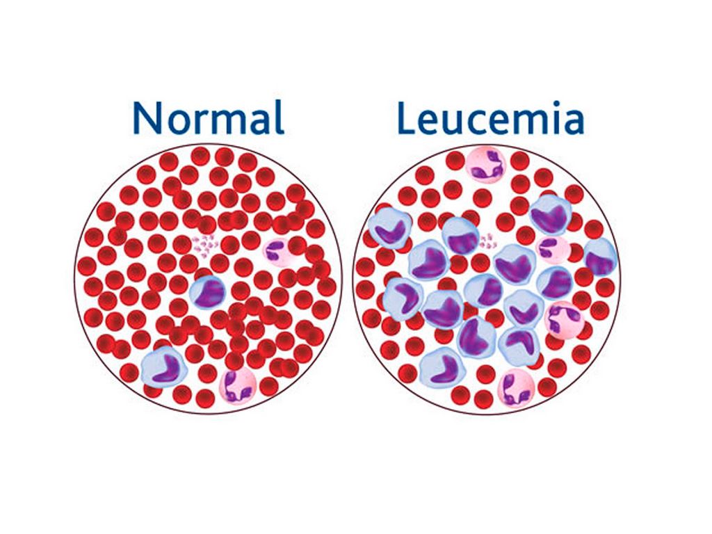 S&iacute;ntomas de leucemia que son silenciosos y podr&iacute;as pasarlos por alto