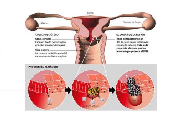 Diagn&oacute;stico y detecci&oacute;n del c&aacute;ncer de cuello de &uacute;tero