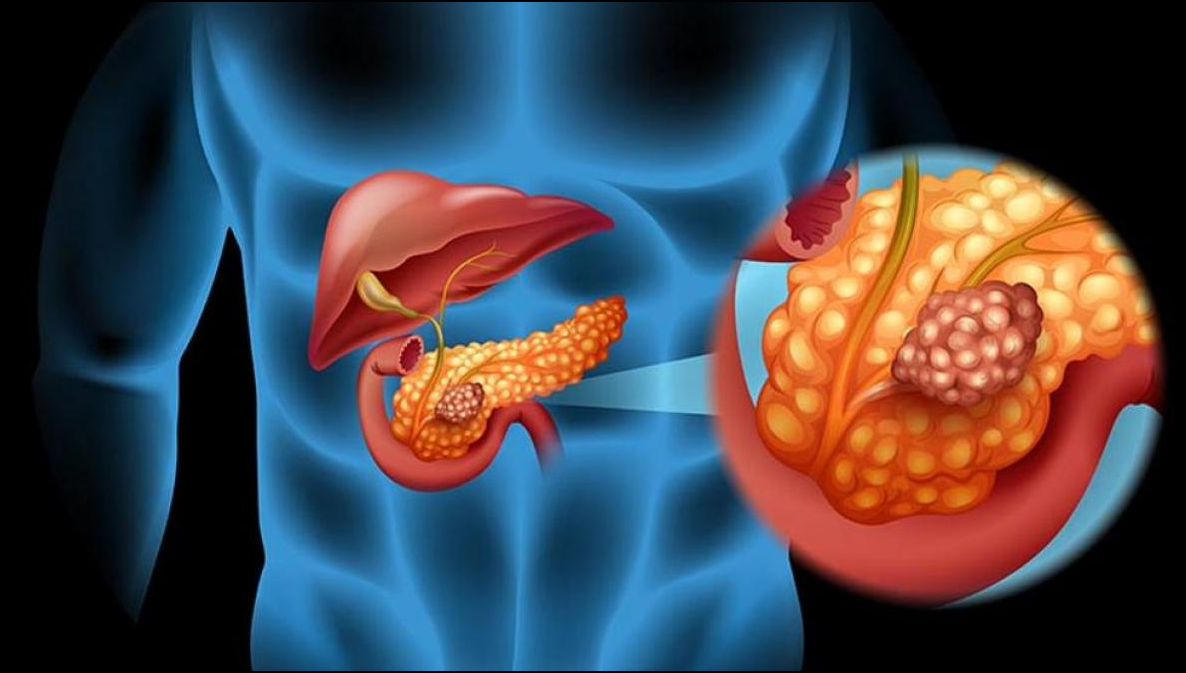  El c&aacute;ncer de p&aacute;ncreas: Cuando el silencio se convierte en sentencia