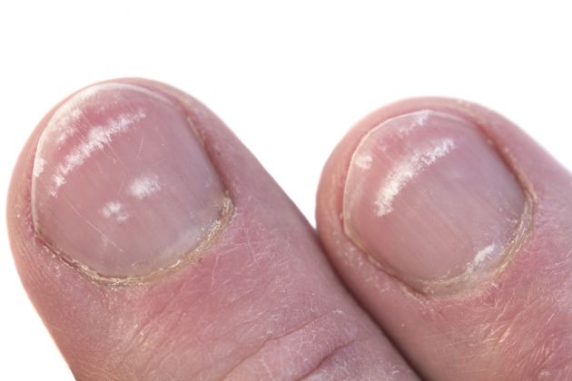 Dime c&oacute;mo tienes las u&ntilde;as y te dir&eacute; qu&eacute; tienes...