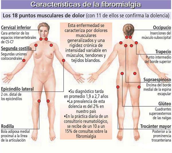 Caracter&iacute;sticas de la fibromialgia