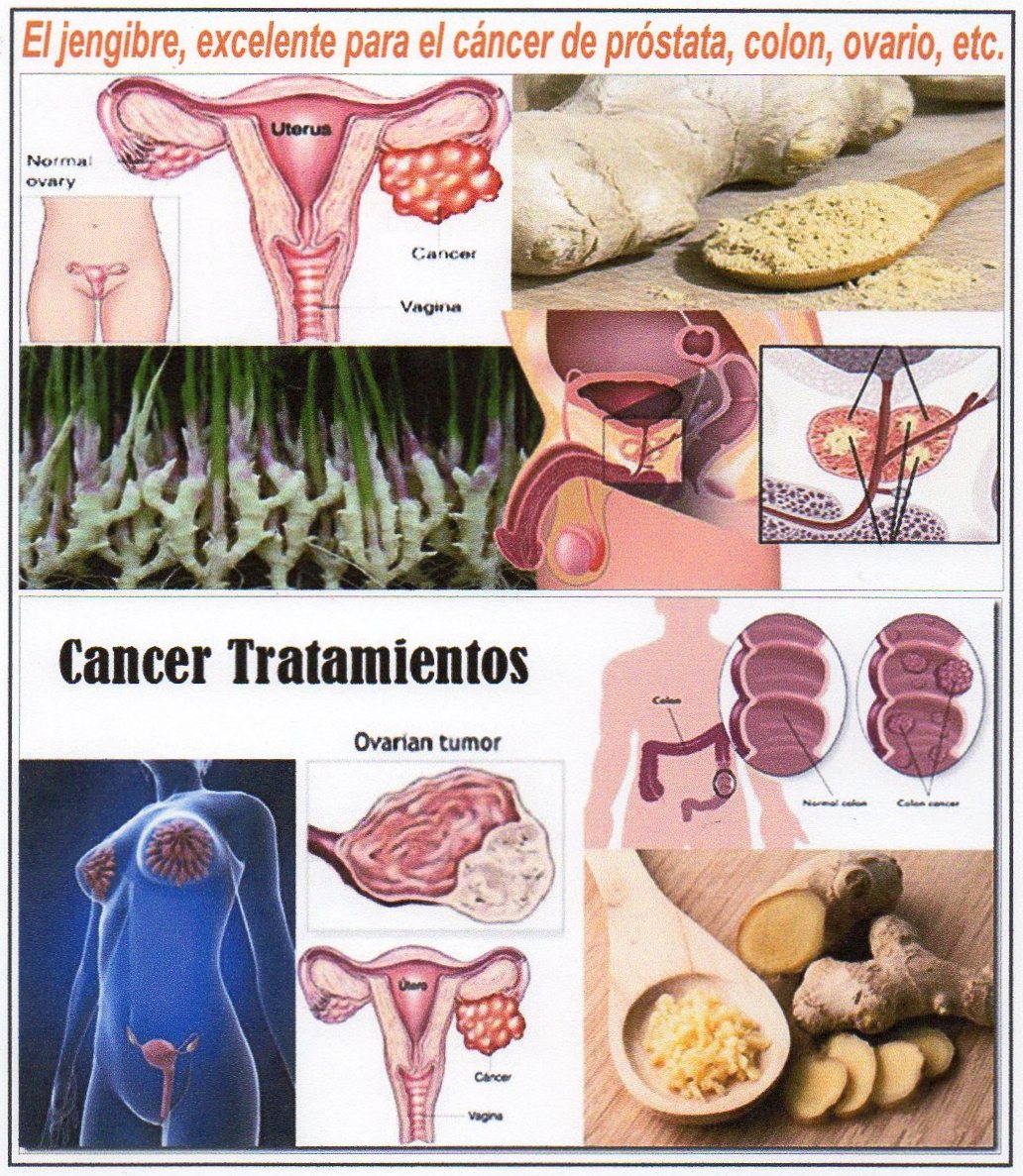  Excelentes resultados del jengibre contra el c&aacute;ncer de pr&oacute;stata, colon, ovario  