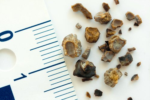 Disolver las piedras en los ri&ntilde;ones con el rompepiedras