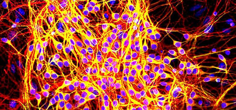 New research finds: Diabetes medications may reduce Alzheimer's disease severity