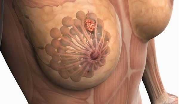 C&oacute;mo prevenir los quistes en los senos
