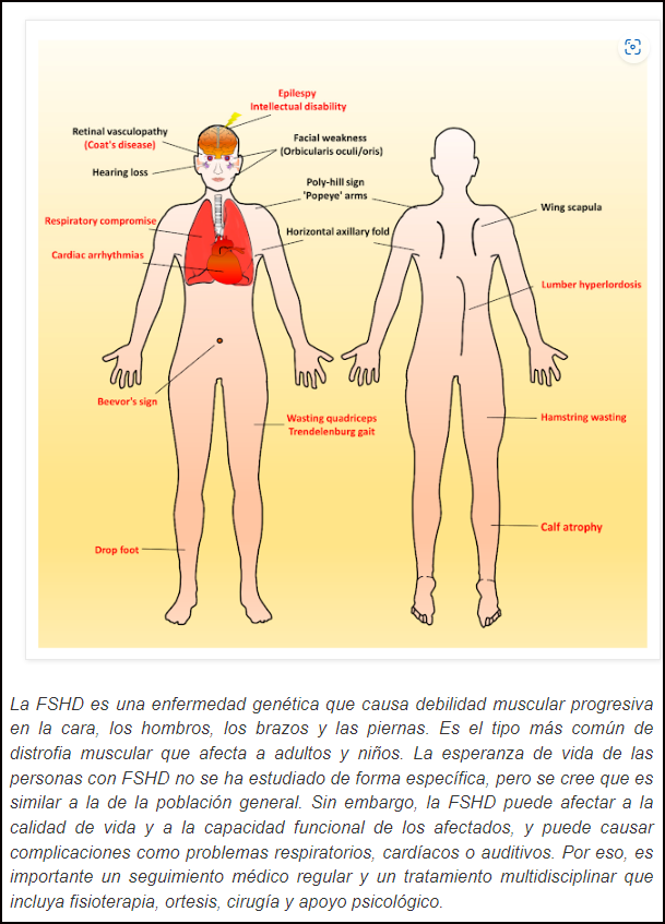 FSHD - Distrofia Facioescapulohumeral