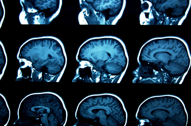El cerebro olvida a prop&oacute;sito para ahorrar energ&iacute;a