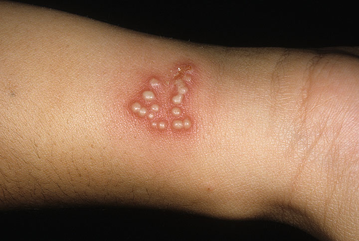  La mitad de la poblaci&oacute;n tiene herpes, seg&uacute;n la OMS