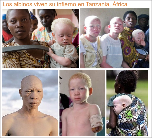 El infierno de ser albino en &Aacute;frica: una verdad aterradora