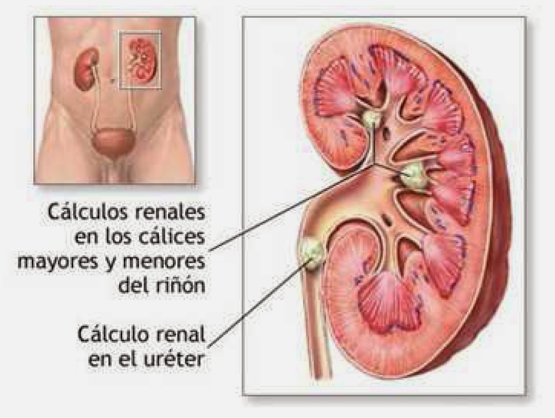 C&oacute;mo saber si tienes c&aacute;lculos renales