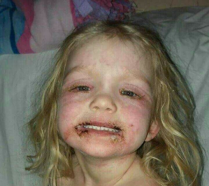Nena de 3 a&ntilde;os hospitalizada con graves heridas tras jugar con juguete 'inofensivo'