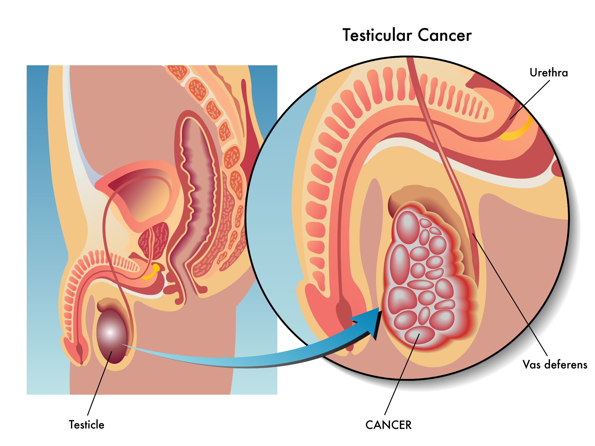 S&iacute;ntomas de c&aacute;ncer testicular, exam&iacute;nese en 3 minutos