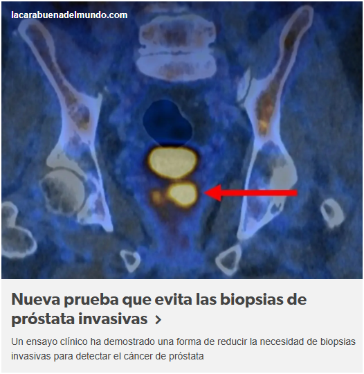 Desarrollan una nueva prueba que reduce la necesidad de biopsias de pr&oacute;stata invasivas