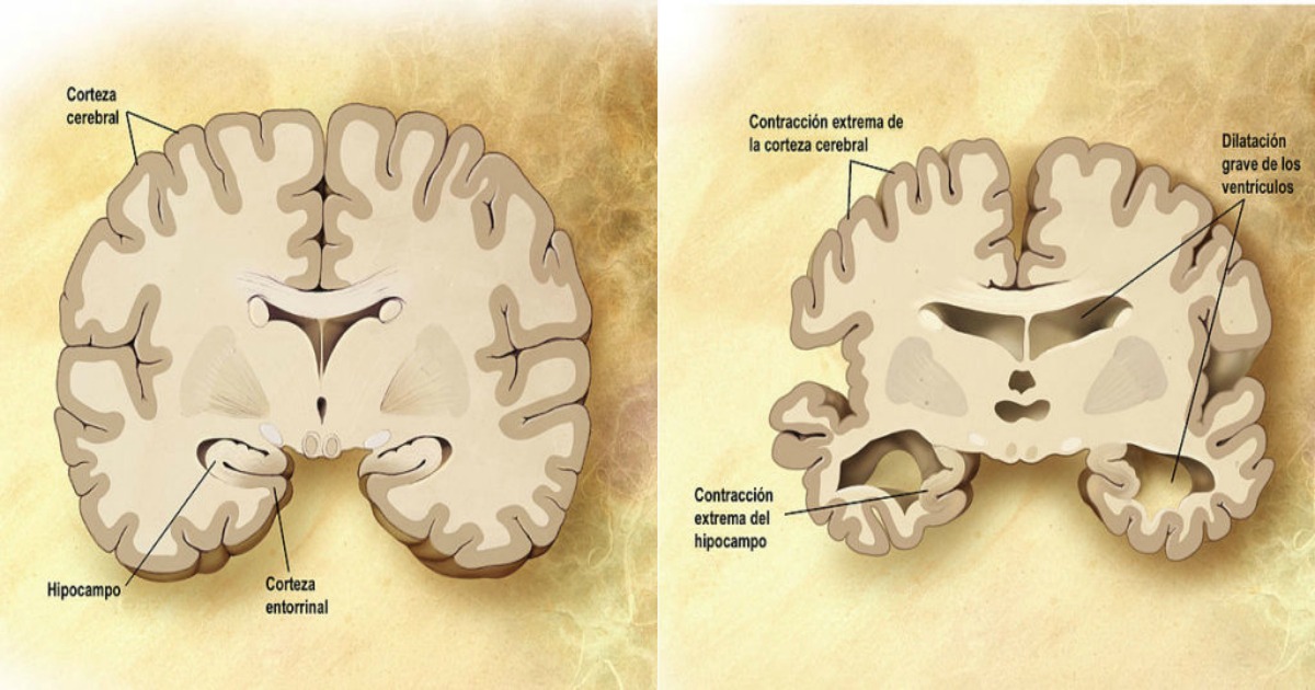 No muchos lo saben, pero la primera se&ntilde;al del Alzheimer no es la p&eacute;rdida de memoria