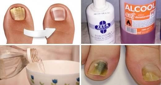 Elimina hongos y manchas amarillas en las u&ntilde;as con este remedio casero