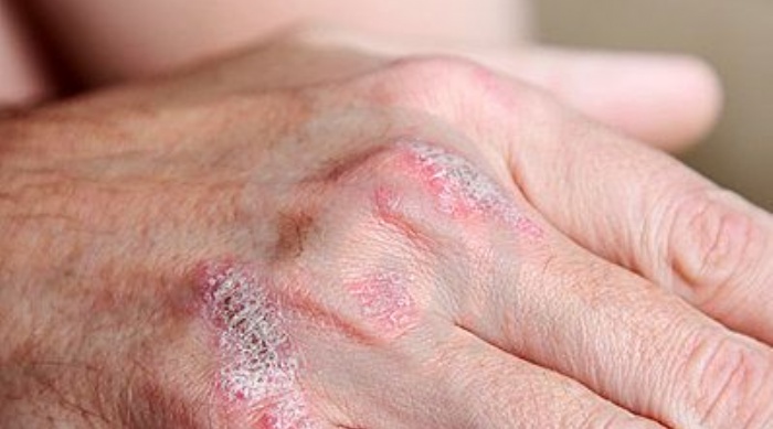 Psoriasis: una enfermedad que afecta a millones