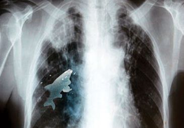 Extrajeron un pez vivo de los pulmones de un ni&ntilde;o
