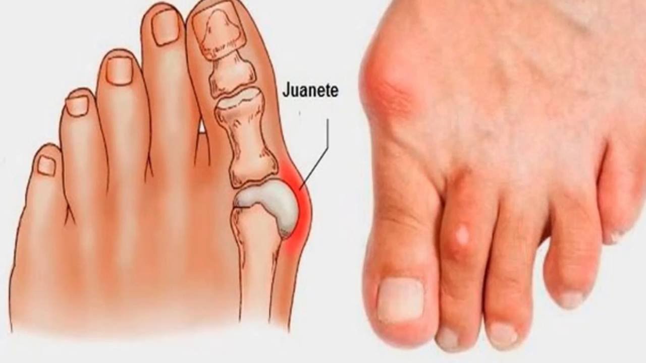 Remedios caseros para el insoportable dolor de los juanetes &iexcl;no tiene falla!